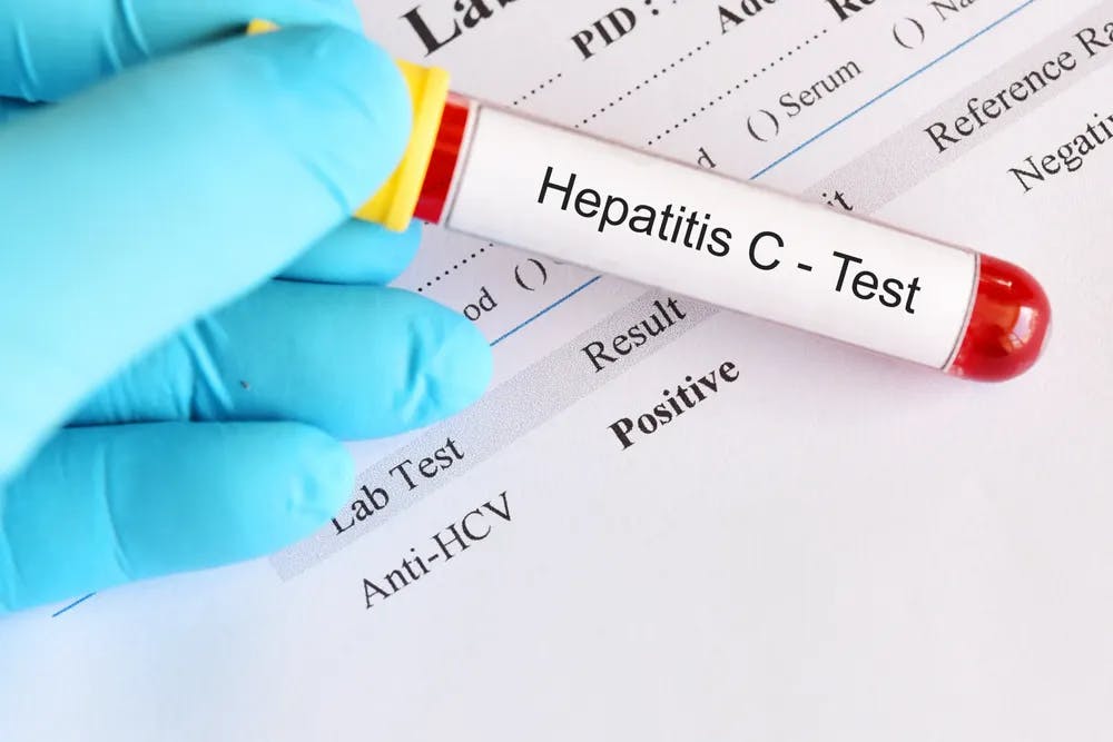 C-hepatiitti kannattaa hoitaa
