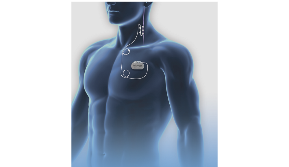 VNS-hoidossa rintaan ihon alle asennetaan generaattori. Se lähettää impulsseja kaulan vagushermoon asennettuihin elektrodeihin, josta ne välittyvät vagushermoa pitkin epilepsiakohtauksia aiheuttavalle aivoalueelle. Generaattoria ohjataan tabletilla.
